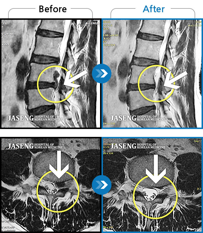 부천자생한방병원 치료사례 MRI로 보는 치료결과-좌측 허리와 골반 통증, 좌측 다리에 통증과 저림