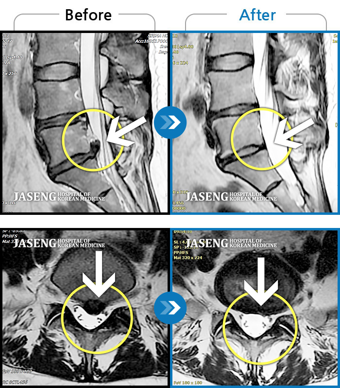 부천자생한방병원 치료사례 MRI로 보는 치료결과-양측 허리와 골반 통증, 양측 다리 저림