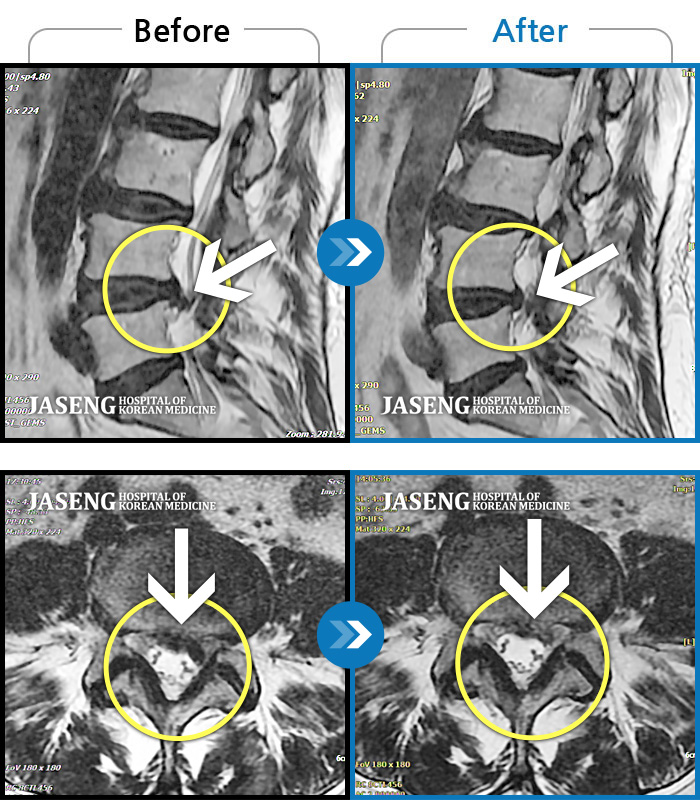 부천자생한방병원 치료사례 MRI로 보는 치료결과-좌측 허리와 골반에 통증, 좌측 다리에 통증과 저림