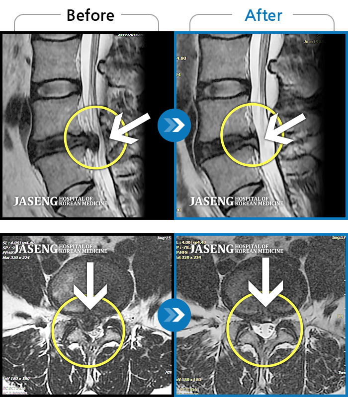 부천자생한방병원 치료사례 MRI로 보는 치료결과-우측 허리 및 골반 통증, 우측 다리에 통증과 저림