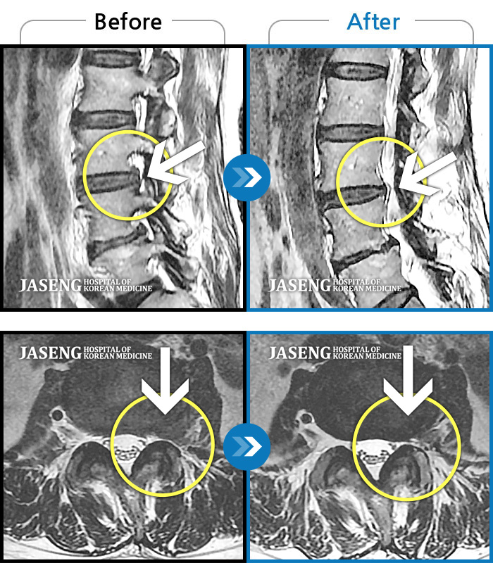 부천자생한방병원 치료사례 MRI로 보는 치료결과-좌측 골반 상연으로 통증과 좌측 대퇴부 통증이 있었다.
