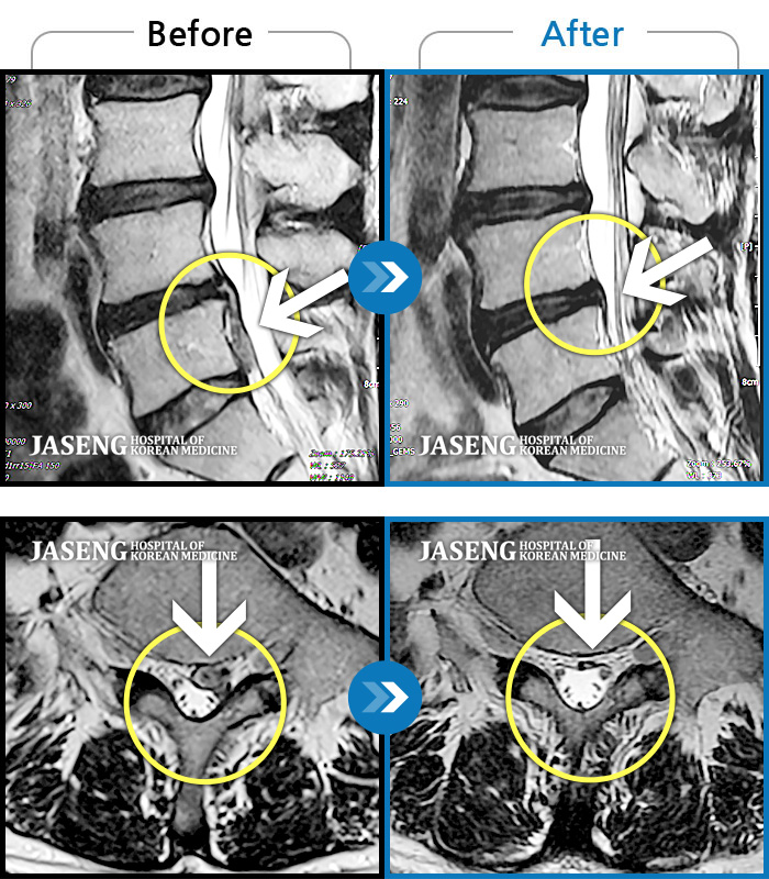 부천자생한방병원 치료사례 MRI로 보는 치료결과-좌측 허리와 골반이 아프고, 좌측 다리에 통증과 저림이 있었다.