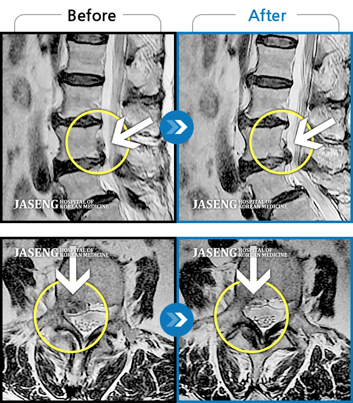 부천자생한방병원 치료사례 MRI로 보는 치료결과-우측 허리와 골반이 아프고, 우측 하지 후면으로 통증이 있다.