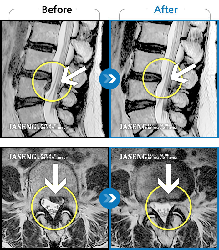 부천자생한방병원 치료사례 MRI로 보는 치료결과-좌측 허리와 골반으로 통증이 있었다.