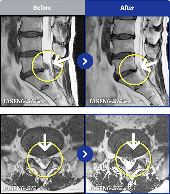�Ȼ��ڻ��ѹ溴�� ġ���� MRI�� ���� ġ����-�㸮 ��� ������ �Բ� �ٸ��� ������ ���� �ȱⰡ �����.