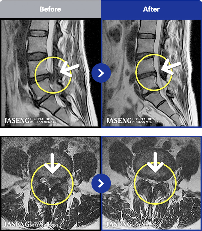 �ڻ��ѹ溴�� ġ���� MRI�� ���� ġ����-�㸮, ���� ��ݺ��� ���� �ٸ��� ���� �� ������ ���ӵǰ�, ���� �ٸ��� ���� ������, ������ ���Ͽ�����, 