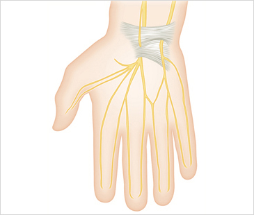 부천자생한방병원 기타관절질환 손목터널증후군-손목터널증후군에 관련된 이미지 입니다.