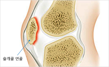 부천자생한방병원 무릎질환 슬개골연골연화증-슬개골 연골이 위치해 있는 무릎 설명 이미지