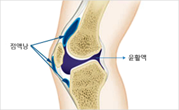 부천자생한방병원 무릎질환 무릎점액낭염-점액낭과 윤활액이 위치해 있는 무릎 설명 이미지