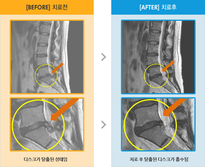 자생한방병원 치료사례 MRI로 보는 치료결과-허리 오른쪽 엉덩이 다리 통증 및 저림