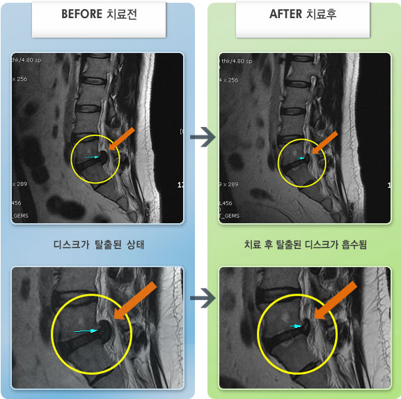 자생한방병원 치료사례 MRI로 보는 치료결과-좌측 다리 통증 때문에 보행 및 좌위시 통증
