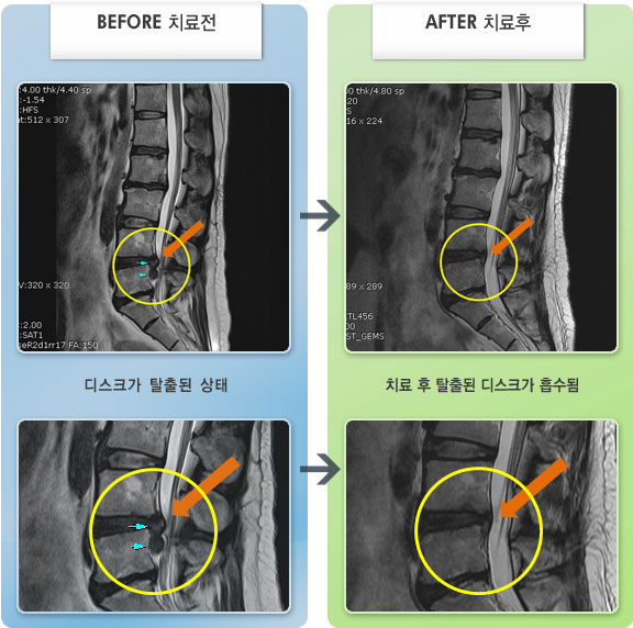 자생한방병원 치료사례 MRI로 보는 치료결과-허리 통증과 좌측 하지 저림이 발가락까지 이어짐
