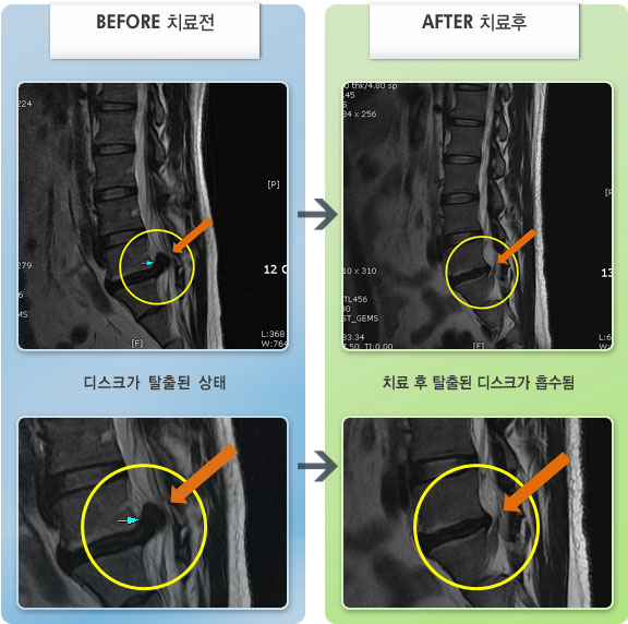 자생한방병원 치료사례 MRI로 보는 치료결과-허리 통증 및 우측 다리 통증이 심하여 허리도 틀어져있고 보행하기도 힘든 상태