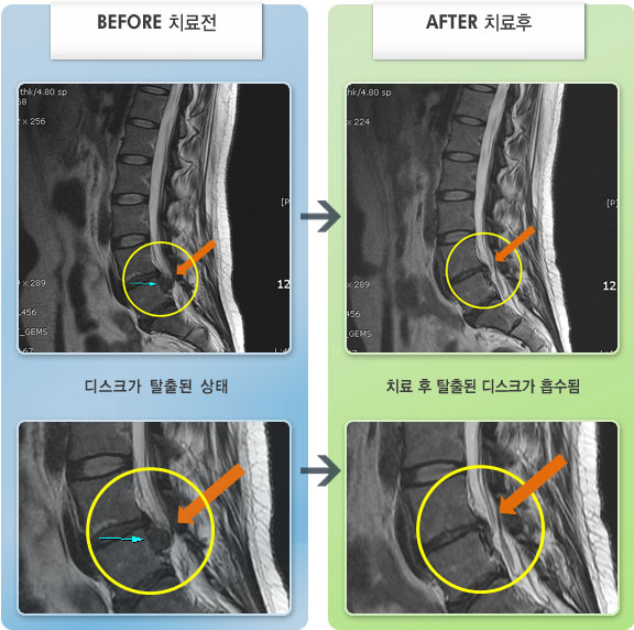 자생한방병원 치료사례 MRI로 보는 치료결과-허리 및 다리의 통증이 심하여 전혀 움직이지 못한 상태