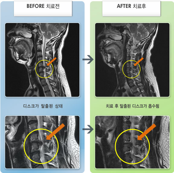 자생한방병원 치료사례 MRI로 보는 치료결과-목과 오른쪽 팔 통증으로 수면이 어려운 상태