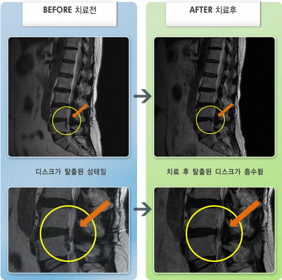 자생한방병원 치료사례 MRI로 보는 치료결과-허리디스크로 인한 좌측 엉덩이 통증