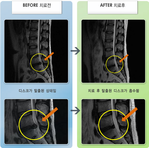 자생한방병원 치료사례 MRI로 보는 치료결과-허리와 왼쪽 엉치 통증 및 대퇴에서 무릎 외측으로 저린통증