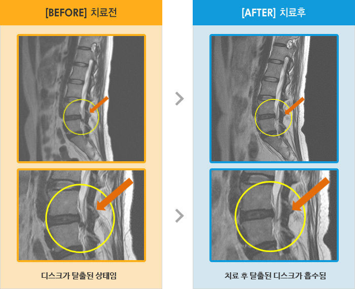 자생한방병원 치료사례 MRI로 보는 치료결과-허리와 왼쪽 엉덩이 통증, 다리와 발은 미약한 통증과 먹먹한 증상