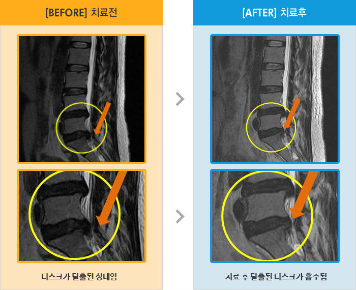 자생한방병원 치료사례 MRI로 보는 치료결과-양측 허리통증과 다리 통증, 저림