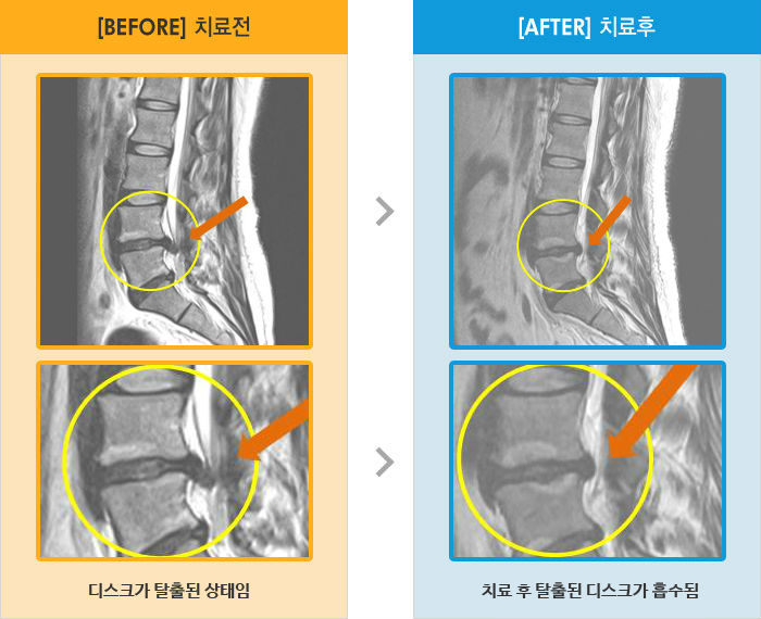 자생한방병원 치료사례 MRI로 보는 치료결과-오른쪽 엉덩이 다리 통증